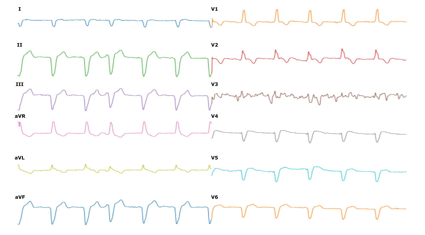 Porovnanie digitalizovaného EKG s papierovým originálom.